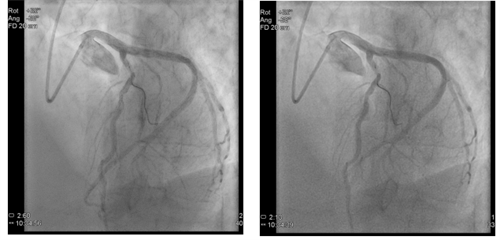 Coronary Angiogram